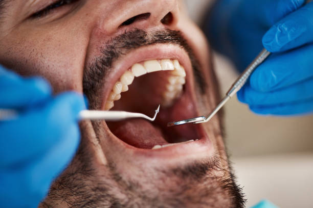Best Emergency Root Canal Treatment in Tipton, IN